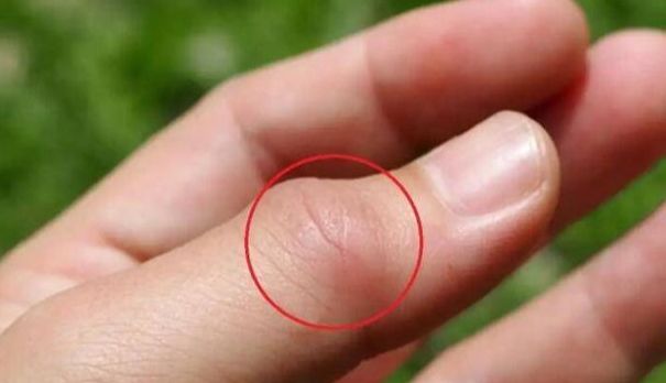 腱鞘炎！这几类人最易中招手腕疼得转不动？小心是(图2)